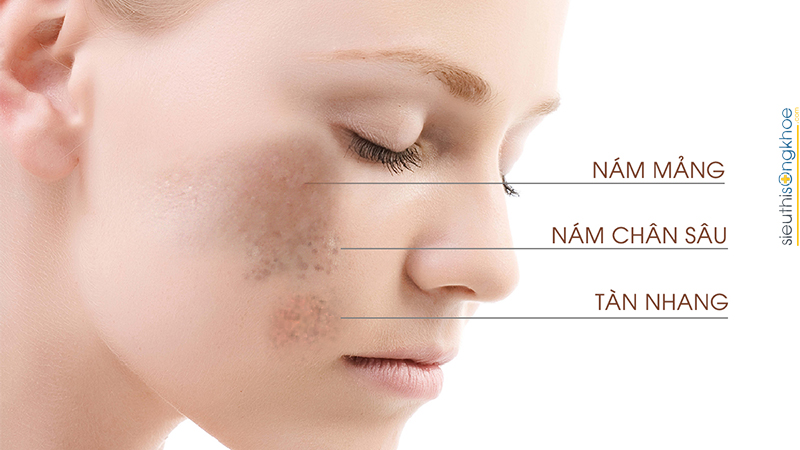 Bột chùm ngây trị nám da tại nhà