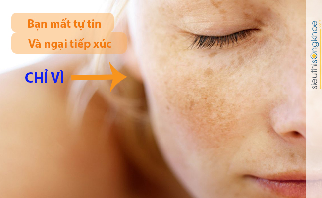 Phương pháp trị nám với chùm ngây