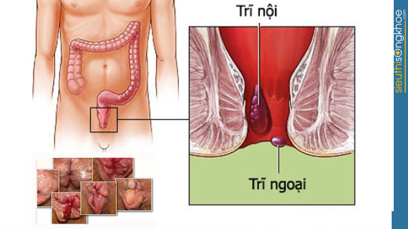 thăng trĩ tán thống giải pháp tối ưu cho người bệnh trĩ