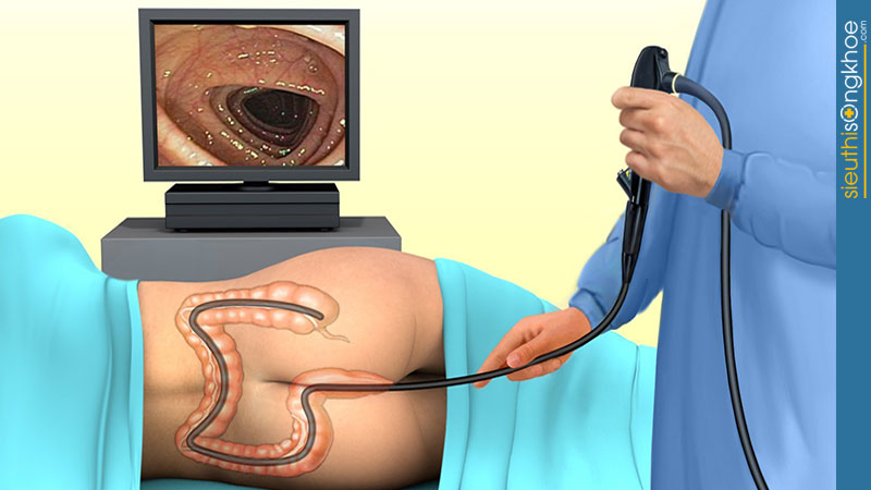 thăng trĩ tán thống giải pháp tối ưu cho người bệnh trĩ