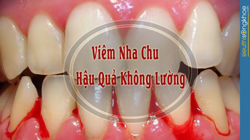 bệnh viêm nha chu