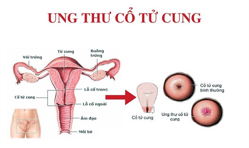 hari-won-lo-tai-phat-ung-thu-co-tu-cung-sau-hai-lan-phau-thuat
