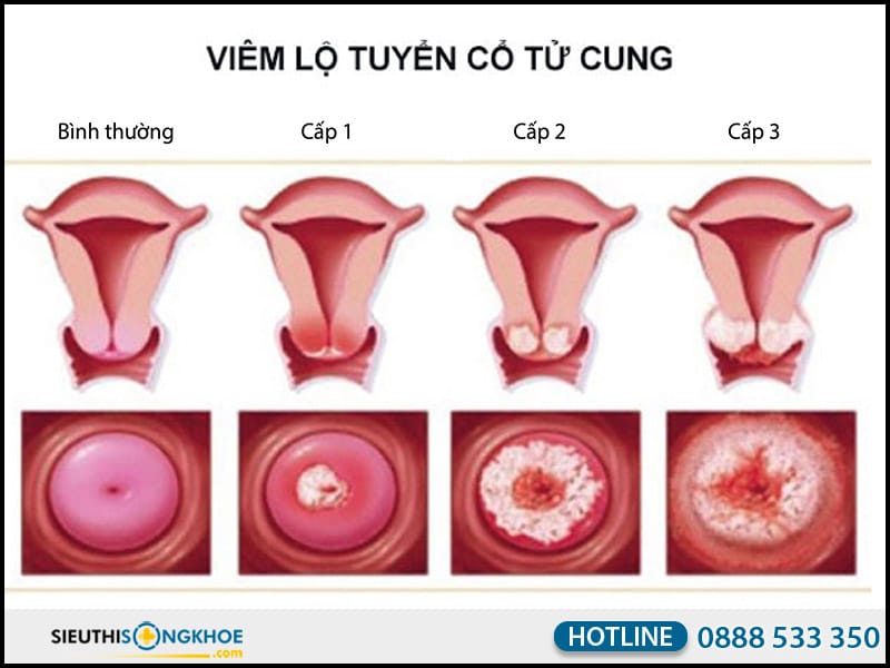 viêm lộ tuyến cổ tử cung