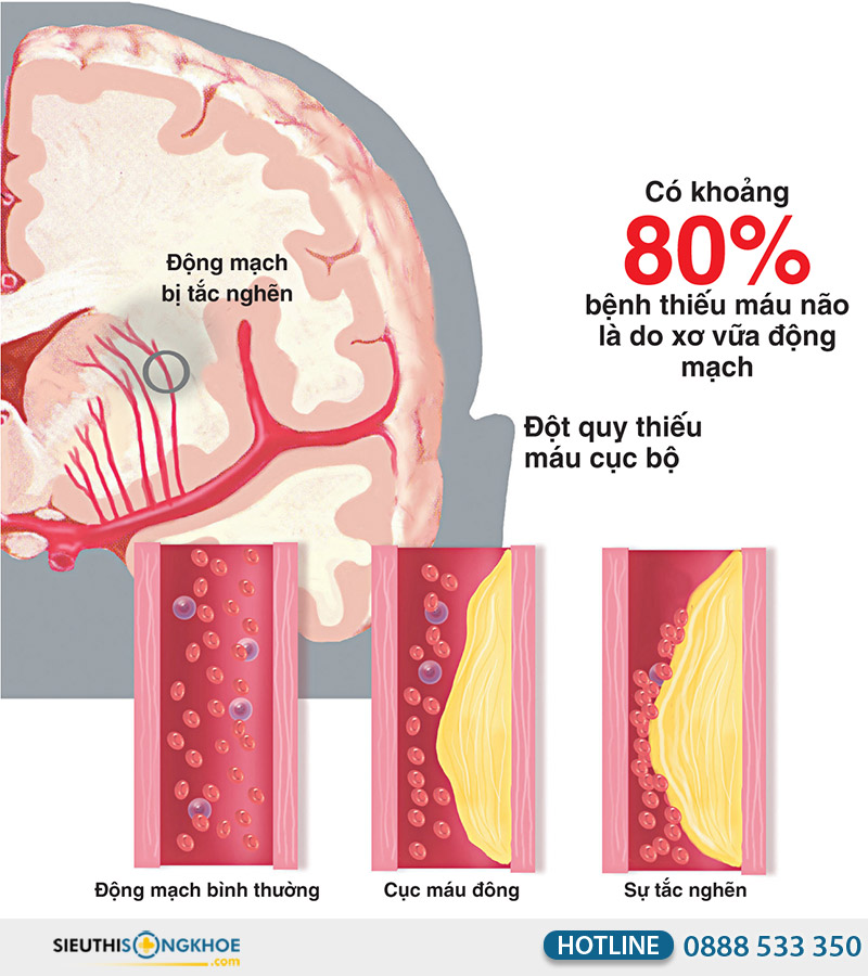 biến chứng bệnh thiếu máu não