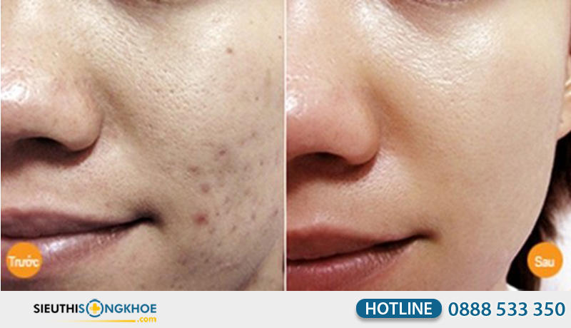 phản hồi khách hàng về obagi tretinoin cream 0.025%