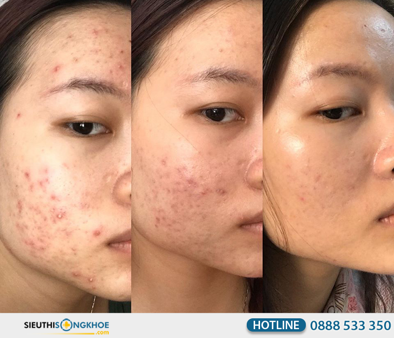 phản hồi khách hàng về obagi tretinoin cream 0.025%