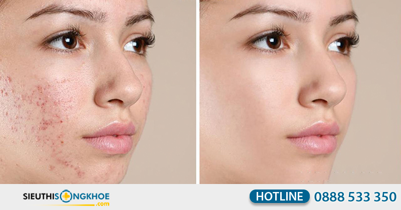 adapalene klenzit ms có tốt không