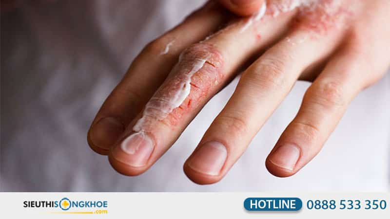 viên uống hỗ trợ trị viêm da
