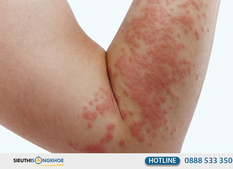 hình ảnh nổi mề đay