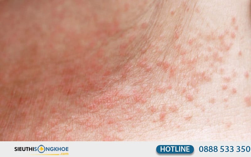 hình ảnh rôm sẩy